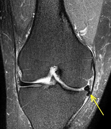 Figure 5 for case Unstable displaced medial meniscus flap tear ( RID2775 )